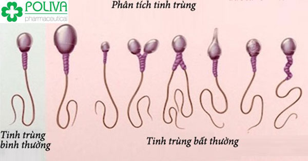 Dị tinh là hiện tượng hình thái tinh trùng không bình thường, có đầu hoặc đuôi bất thường