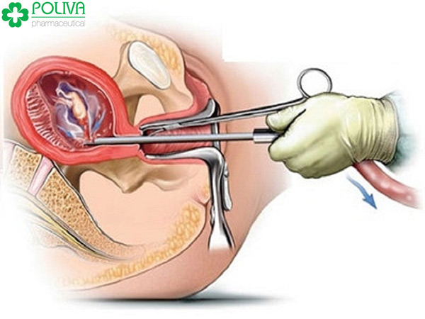 Phá thai là thủ thuật để chấm dứt kỳ thai nghén nhanh chóng.