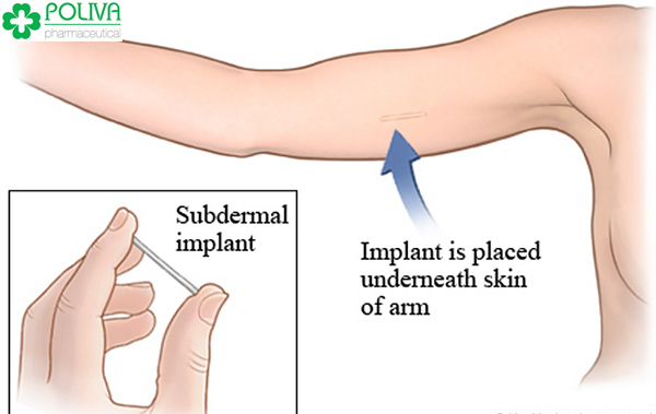 Que cấy tránh thai sẽ được cấy vào vùng tay dưới da (thường là ở tay không thuận)