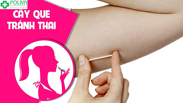 Que cấy tránh thai là một phương pháp kế hoạch hóa gia đình mới ở Việt Nam