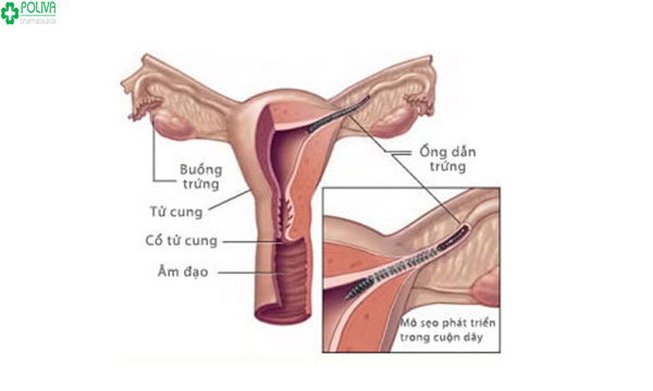 Triệt sản nữ khiến người mẹ không có khả năng làm mẹ