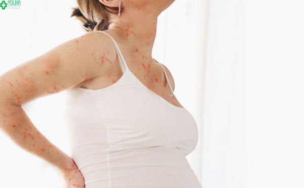 Viêm nang lông là một trong các lý do khiến mẹ bầu bị ngứa khi mang thai