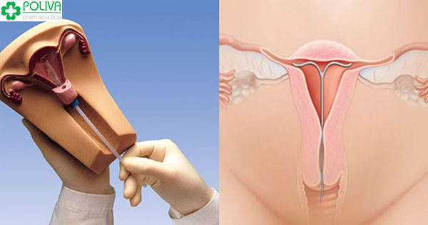 Quy trình đặt vòng sau sinh diễn ra khá nhanh nhưng cũng khiến phụ nữ bị đau