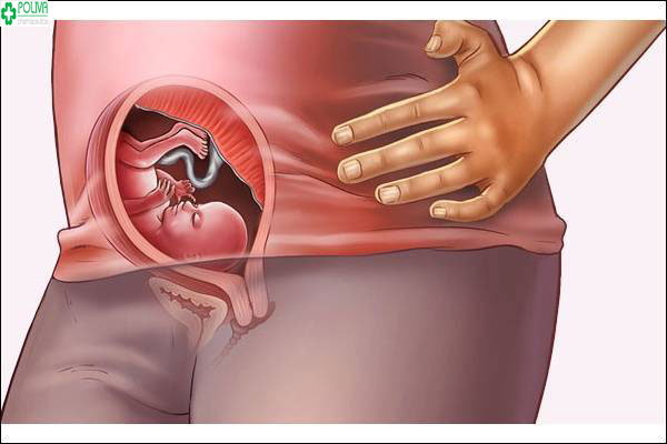 Nếu có dấu hiệu nước ối bất thường có thể mẹ có nguy cơ bị suy thai