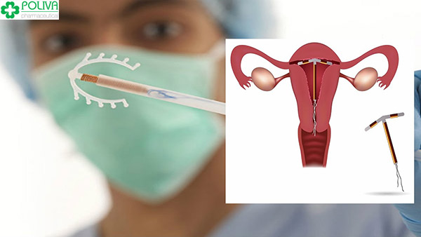 Thủ thuật đặt vòng tránh thai cần được bác sỹ có chuyên môn thực hiện.