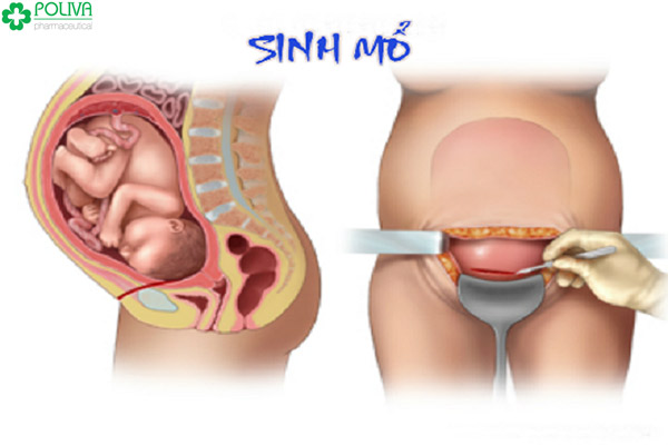 Hậu quá trình đẻ mổ, các mẹ vất vả rất nhiều