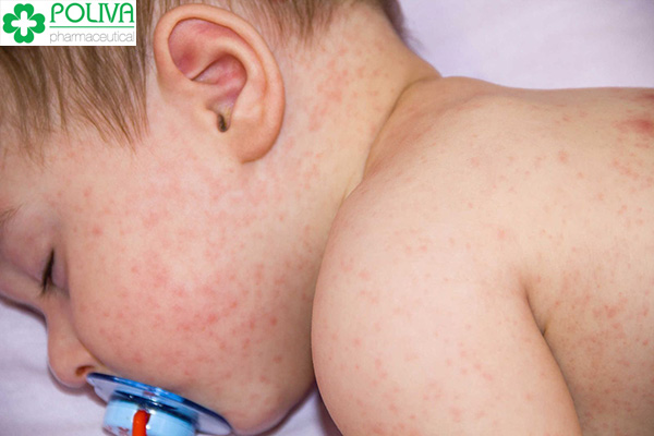 Sau 1-2 tuần bé sẽ xuất hiện các dấu hiệu của bệnh sốt phát ban.