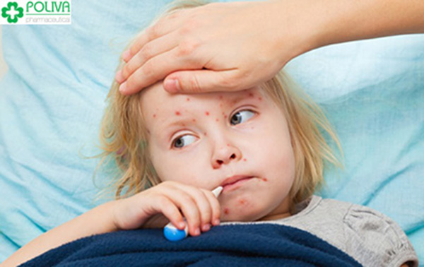 Trẻ bị sởi thường có triệu chứng sốt cao.