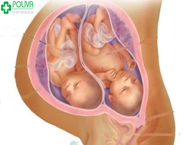 Cân nặng thai nhi nhỏ hơn bình thường khi mẹ mang đa thai