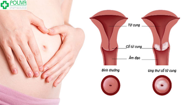 Đau bụng kinh là dấu hiệu của nguy cơ mắc bệnh ung thư cổ tử cung