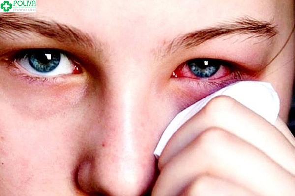 Hiện tượng đau mắt đỏ bao lâu thì khỏi? Đau mắt đỏ kiêng gì?
