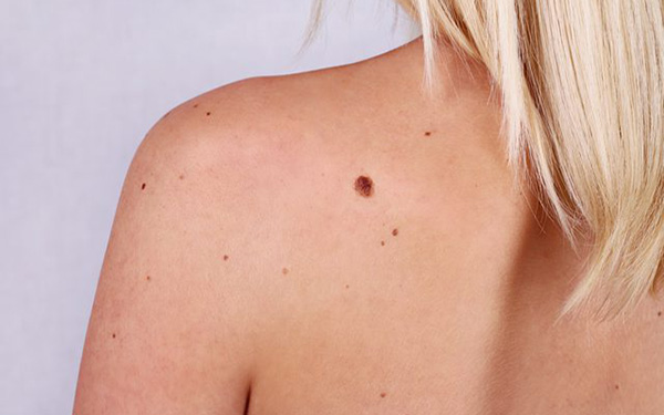 Melanoma là gì? Đọc ngay để biết về căn bệnh ung thư da nguy hiểm nhất này