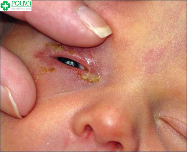 Nhỏ sữa mẹ vào mắt trẻ dẫn đến tình trạng viêm, loét gây hỏng mắt