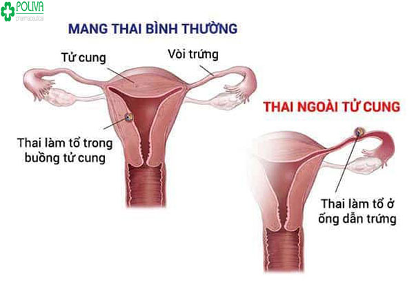Thai ngoài tử cung là thai nhi không nằm trong tử cung của mẹ