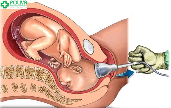 Phá thai 1 tháng tuổi có thể để lại nhiều biến chứng