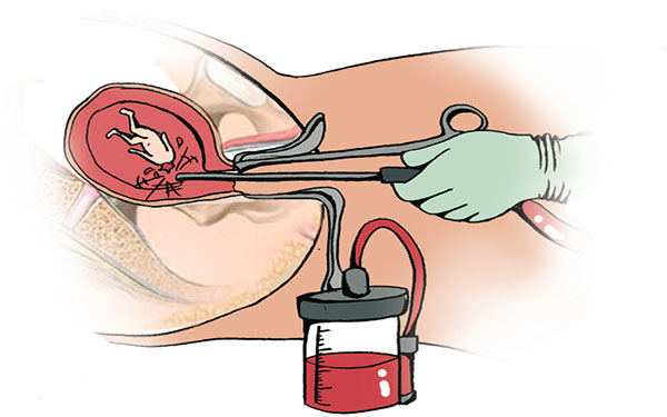 Sử dụng cách nạo, phá thai