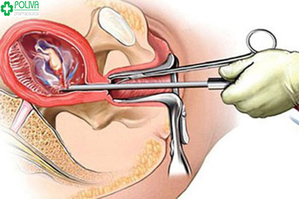 Hút thai 5 tuần tuổi có đau không áp dụng cho đối tượng nào?