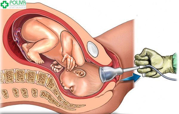 Hút thai để lại vô số biến chứng và nguy hiểm