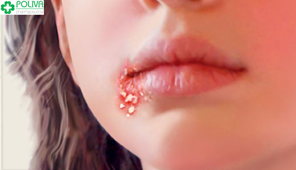 Quan hệ bằng miệng có nguy cơ lây những bệnh truyền nhiễm xã hội