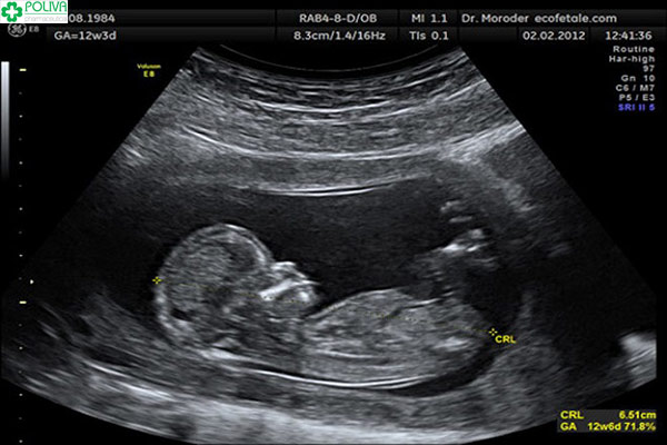 Hình ảnh siêu âm thai nhi 12 tuần