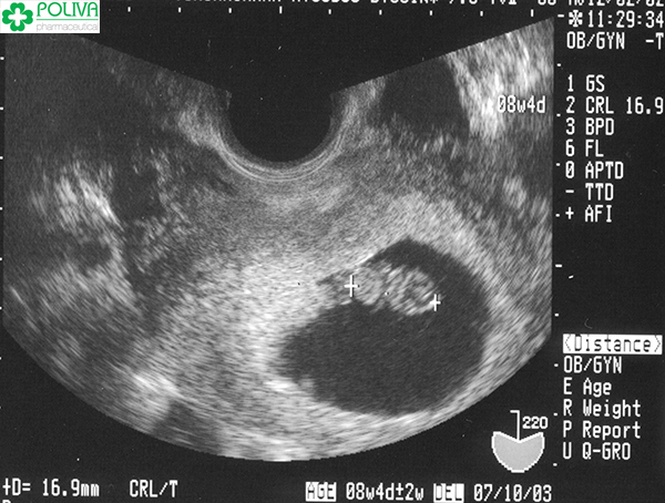 Hình ảnh siêu âm thai nhi 8 tuần