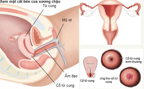 Viêm lộ tuyến cổ tử cung