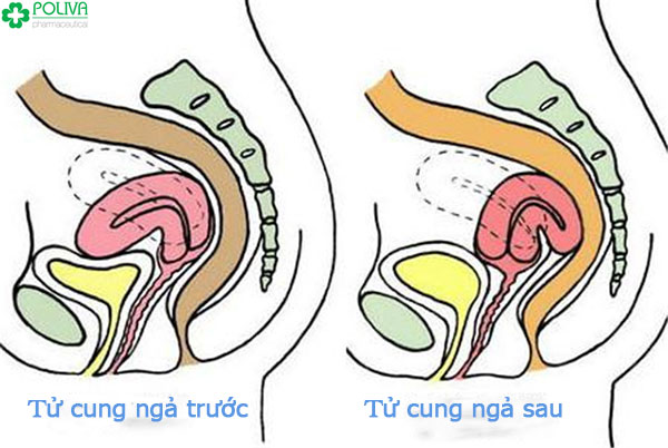 Tư thế tử cung ngả trước và ngả sau