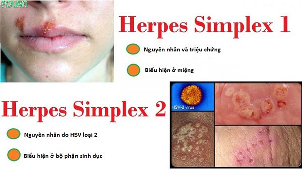 Các thể virus Herpes