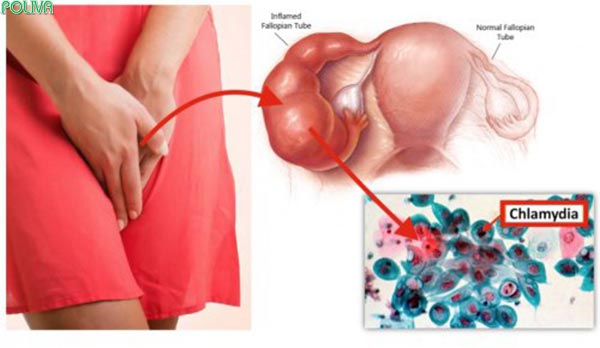 Nhiễm nấm Chlamydia có thể gây vô sinh ở nữ giới